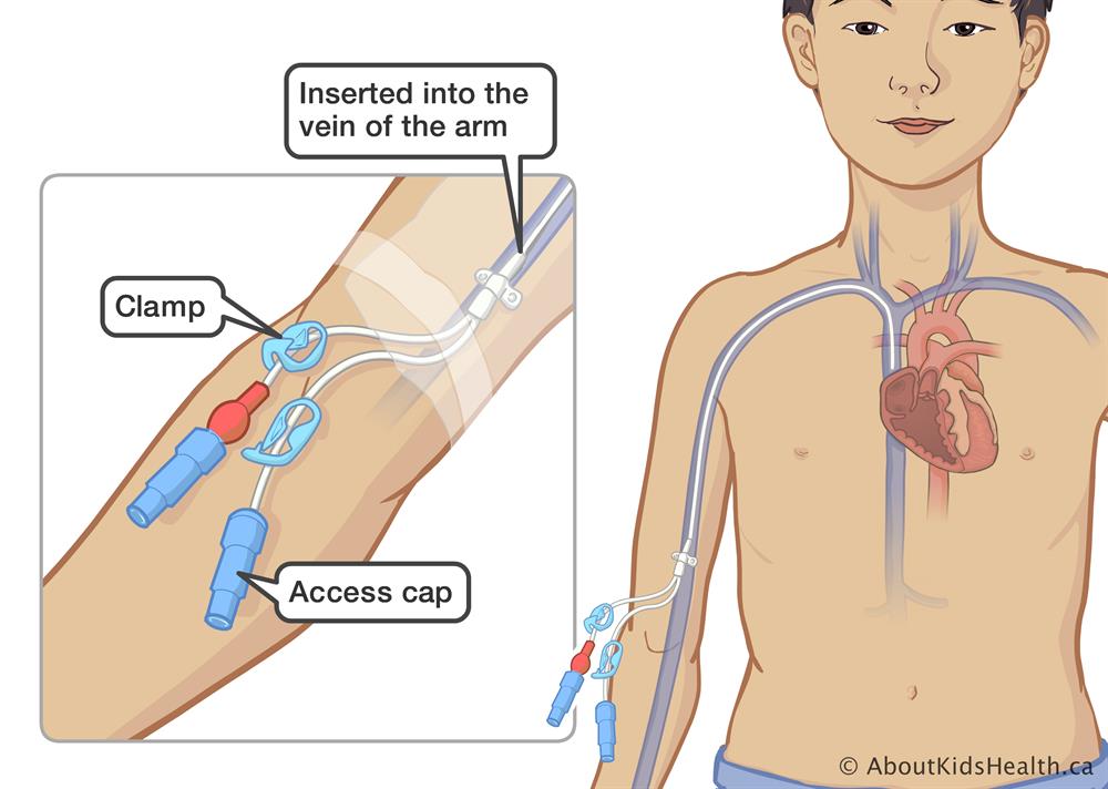 PICC Line